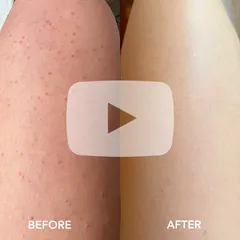 Dr Dennis Gross - Alpha Beta Exfoliating Body Treatment Peel | Dr. Dennis Gross