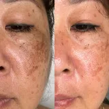 Dark Spot Fix