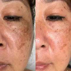 SLMD Skincare by Sandra Lee, M.D. - Dr. Pimple Popper - Dark Spot Fix